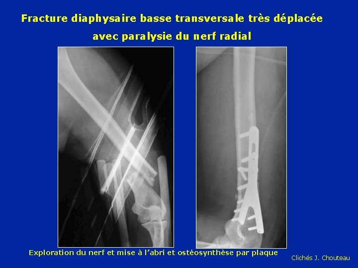 Fracture diaphysaire basse transversale très déplacée avec paralysie du nerf radial Exploration du nerf