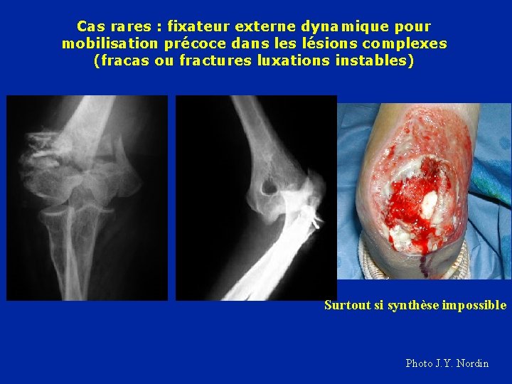 Cas rares : fixateur externe dynamique pour mobilisation précoce dans les lésions complexes (fracas