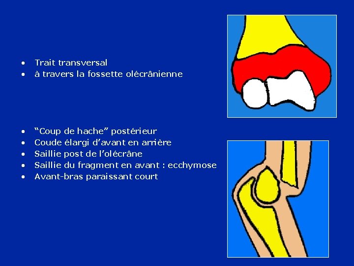  • • Trait transversal à travers la fossette olécrânienne • • • “Coup