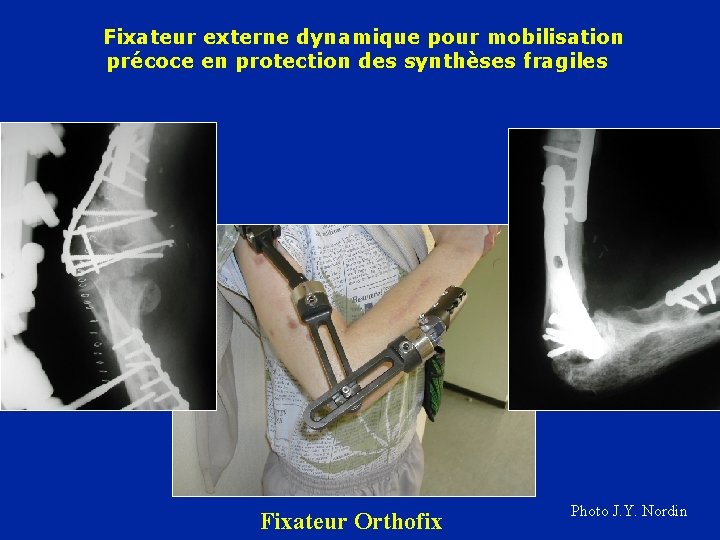 Fixateur externe dynamique pour mobilisation précoce en protection des synthèses fragiles Fixateur Orthofix Photo