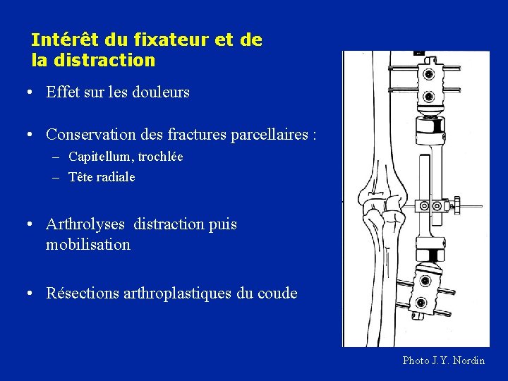 Intérêt du fixateur et de la distraction • Effet sur les douleurs • Conservation