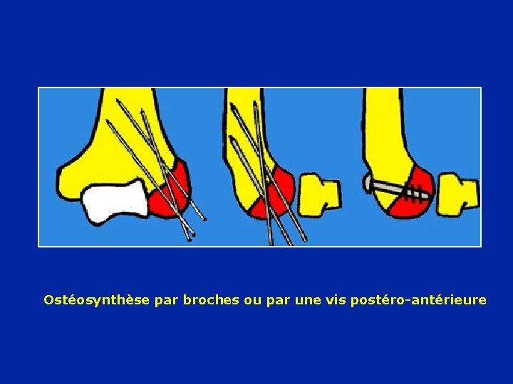 Ostéosynthèse par broches ou par une vis postéro-antérieure 
