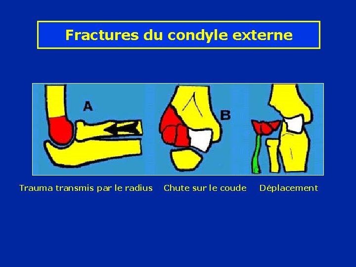 Fractures du condyle externe Trauma transmis par le radius Chute sur le coude Déplacement