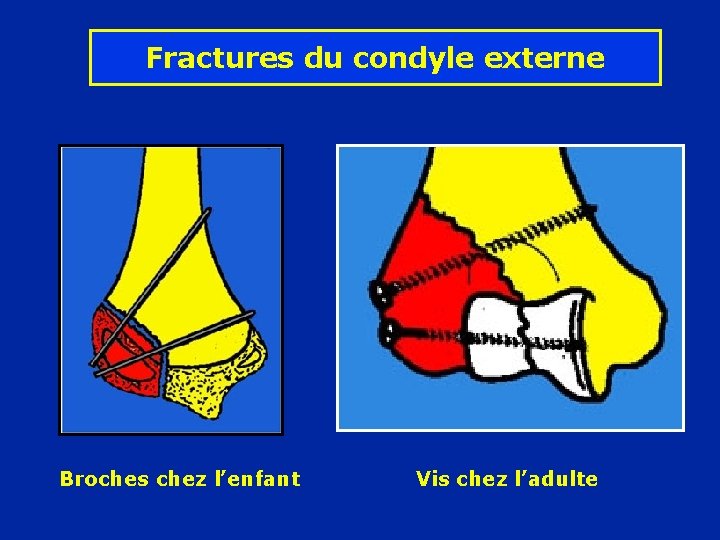 Fractures du condyle externe Broches chez l’enfant Vis chez l’adulte 