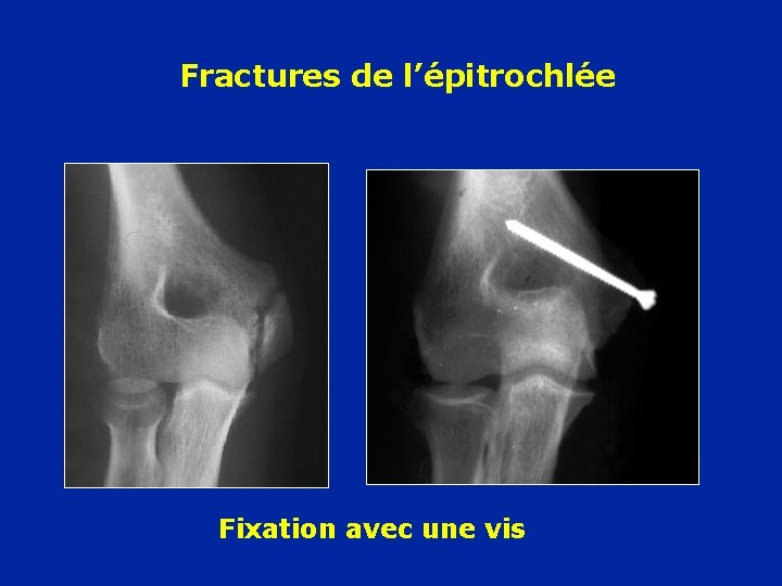 Fractures de l’épitrochlée Fixation avec une vis 