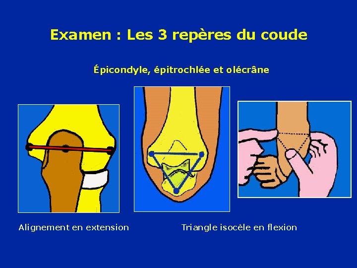 Examen : Les 3 repères du coude Épicondyle, épitrochlée et olécrâne Alignement en extension