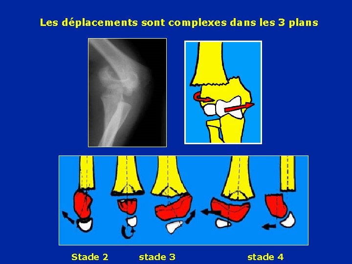 Les déplacements sont complexes dans les 3 plans Stade 2 stade 3 stade 4