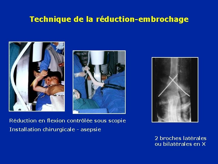 Technique de la réduction-embrochage Réduction en flexion contrôlée sous scopie Installation chirurgicale - asepsie