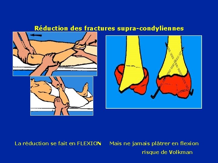 Réduction des fractures supra-condyliennes La réduction se fait en FLEXION Mais ne jamais plâtrer