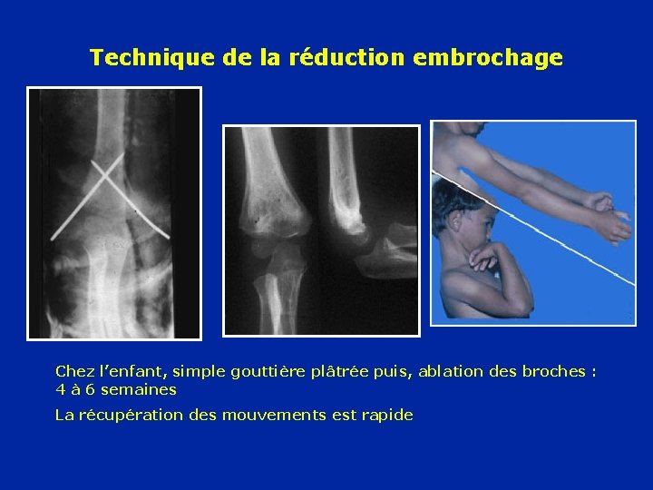 Technique de la réduction embrochage Chez l’enfant, simple gouttière plâtrée puis, ablation des broches