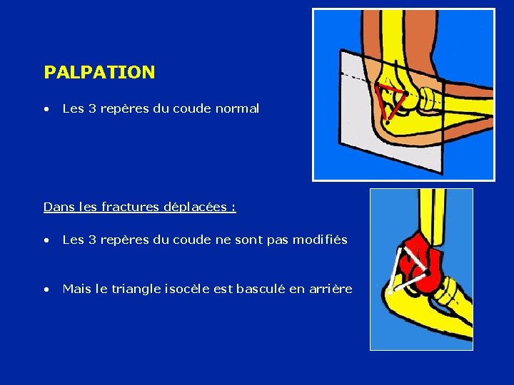 PALPATION • Les 3 repères du coude normal Dans les fractures déplacées : •