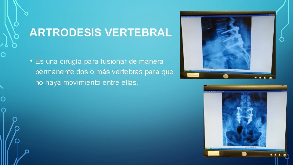 ARTRODESIS VERTEBRAL • Es una cirugía para fusionar de manera permanente dos o más