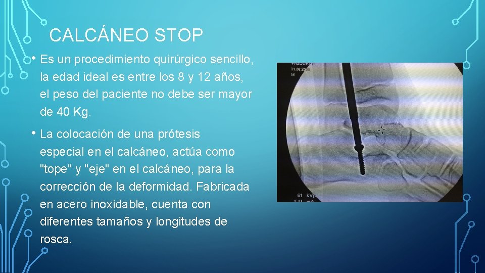 CALCÁNEO STOP • Es un procedimiento quirúrgico sencillo, la edad ideal es entre los