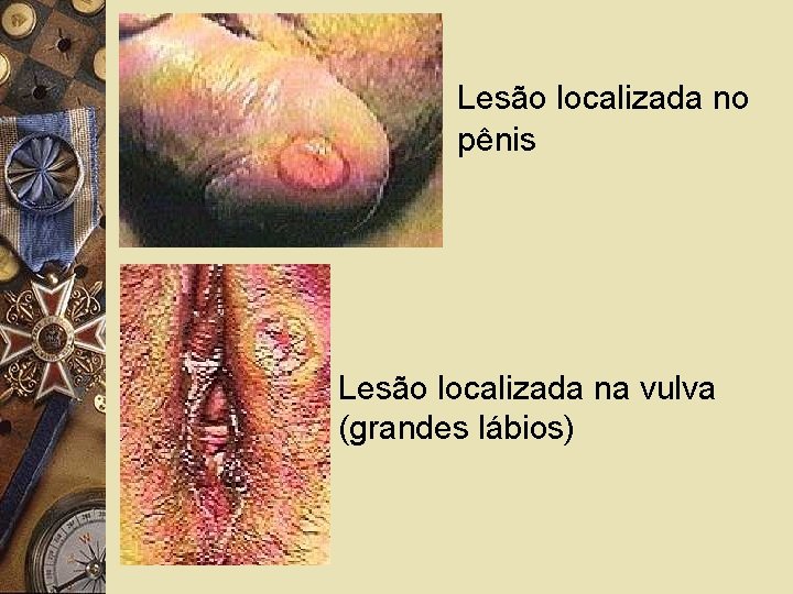 Lesão localizada no pênis Lesão localizada na vulva (grandes lábios) 
