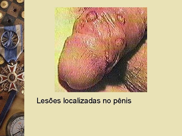 Lesões localizadas no pênis 