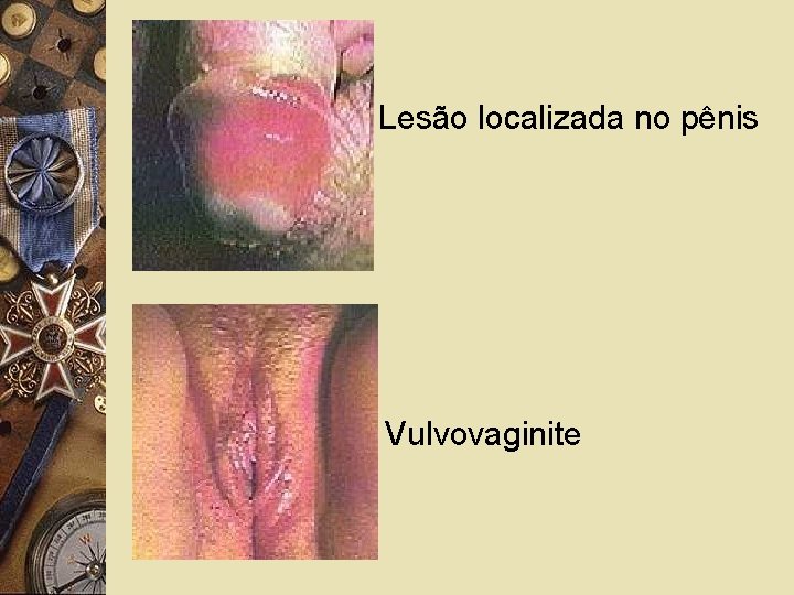 Lesão localizada no pênis Vulvovaginite 