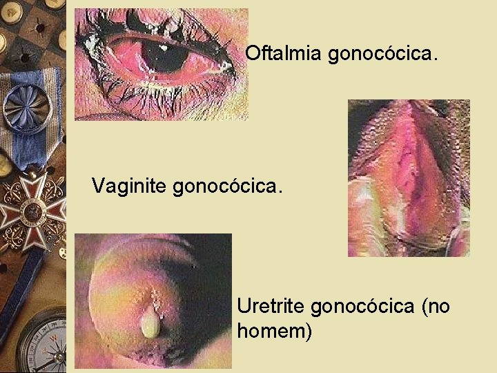 Oftalmia gonocócica. Vaginite gonocócica. Uretrite gonocócica (no homem) 