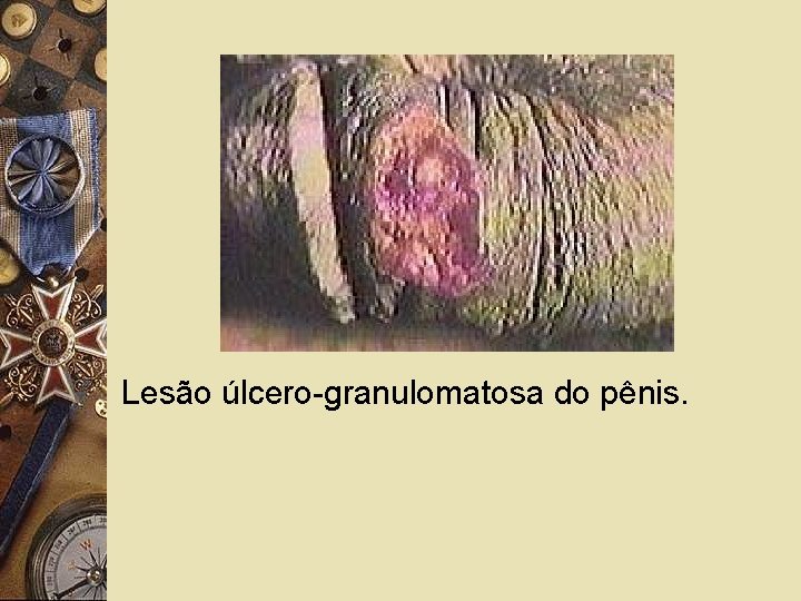 Lesão úlcero-granulomatosa do pênis. 