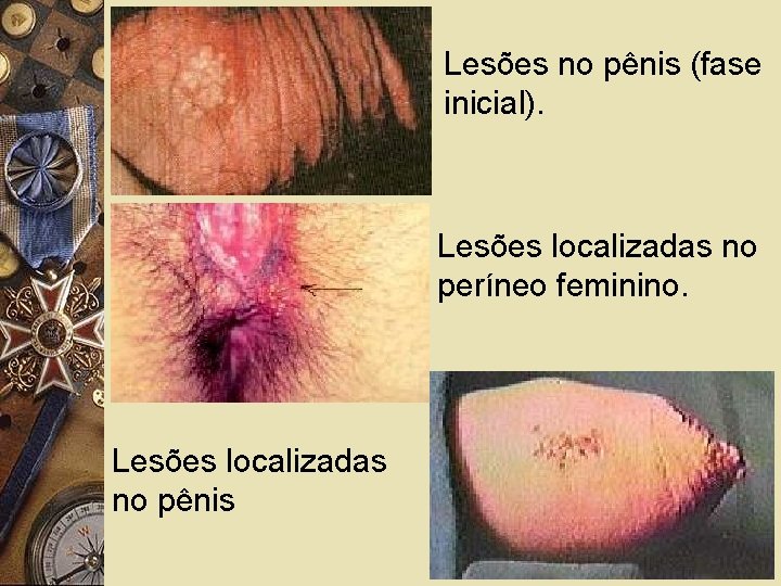 Lesões no pênis (fase inicial). Lesões localizadas no períneo feminino. Lesões localizadas no pênis