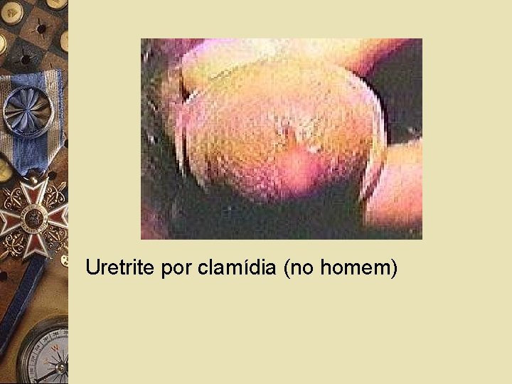  Uretrite por clamídia (no homem) 