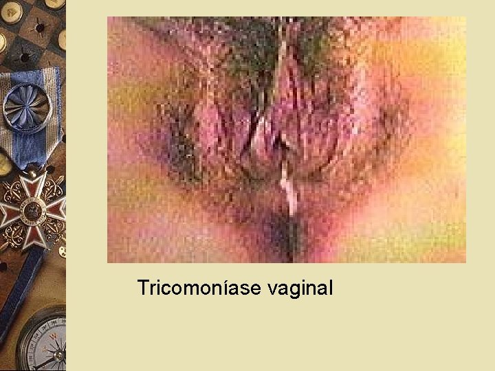 Tricomoníase vaginal 
