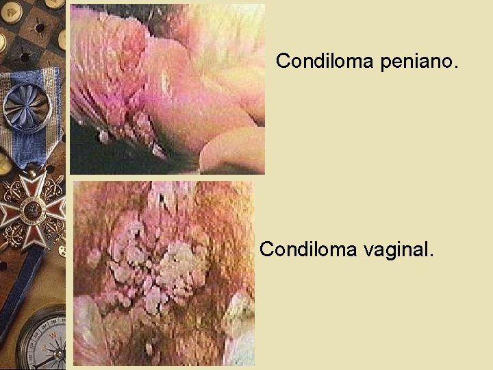 Condiloma peniano. Condiloma vaginal. 
