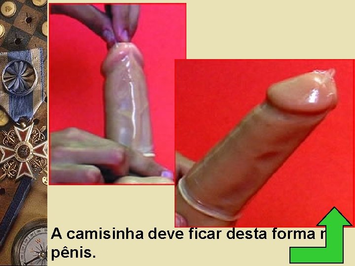 A camisinha deve ficar desta forma no pênis. 