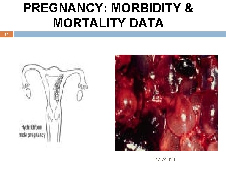 PREGNANCY: MORBIDITY & MORTALITY DATA 11 11/27/2020 