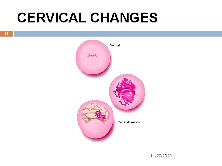 CERVICAL CHANGES 14 11/27/2020 