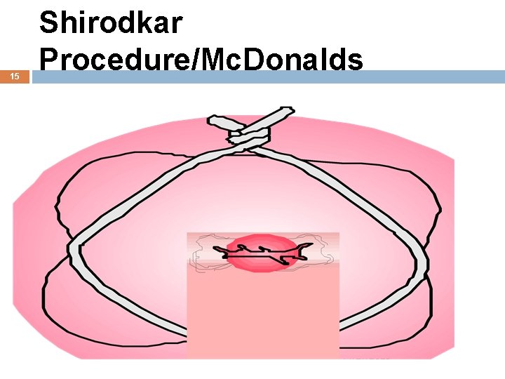 15 Shirodkar Procedure/Mc. Donalds 11/27/2020 