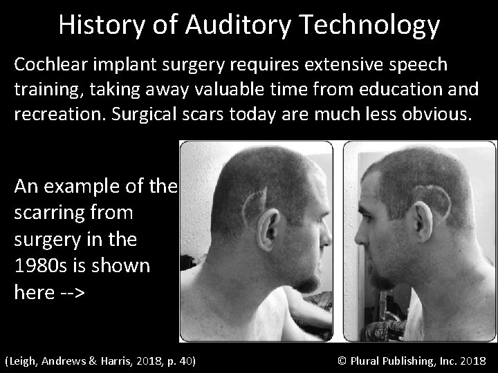 History of Auditory Technology Cochlear implant surgery requires extensive speech training, taking away valuable