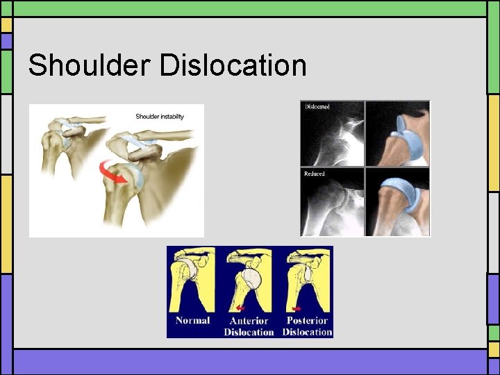 Shoulder Dislocation Shoulder Dislocation
