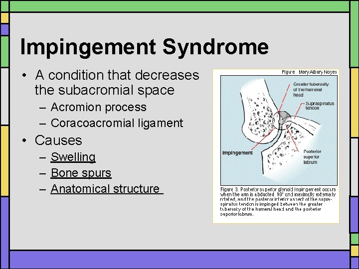 Impingement Syndrome • A condition that decreases the subacromial space – Acromion process – Impingement Syndrome • A condition that decreases the subacromial space – Acromion process –