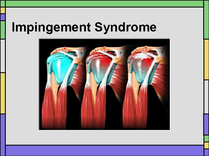 Impingement Syndrome Impingement Syndrome