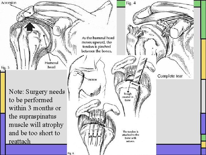 Note: Surgery needs to be performed within 3 months or the supraspinatus muscle will Note: Surgery needs to be performed within 3 months or the supraspinatus muscle will