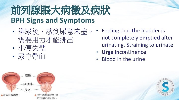 前列腺脹大病徵及病狀 BPH Signs and Symptoms 排尿後，感到尿意未盡， • 需要用力才能排出 • 小便失禁 • • 尿中帶血 •