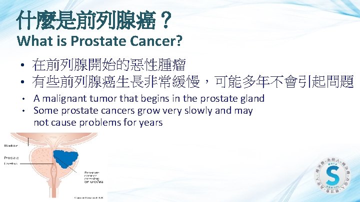 什麼是前列腺癌？ What is Prostate Cancer? • • 在前列腺開始的惡性腫瘤 有些前列腺癌生長非常緩慢，可能多年不會引起問題 • • A malignant tumor