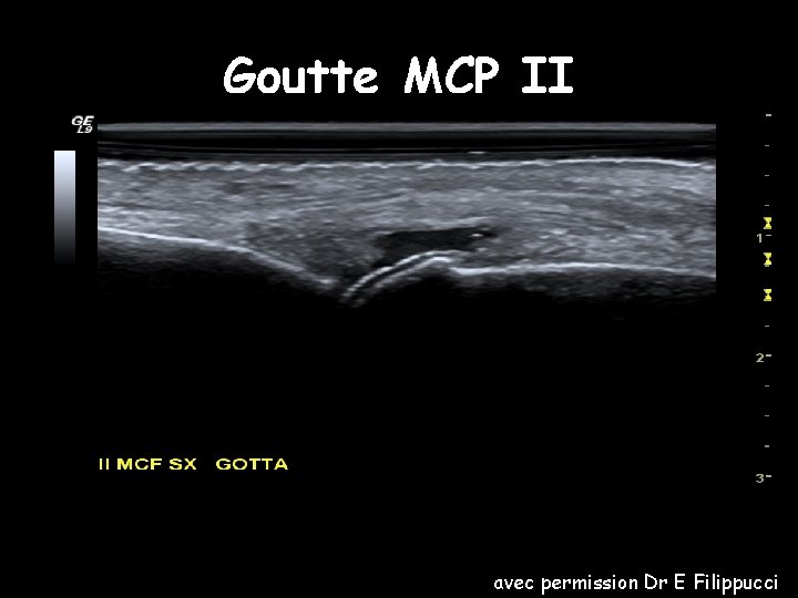 Goutte MCP II avec permission Dr E Filippucci 