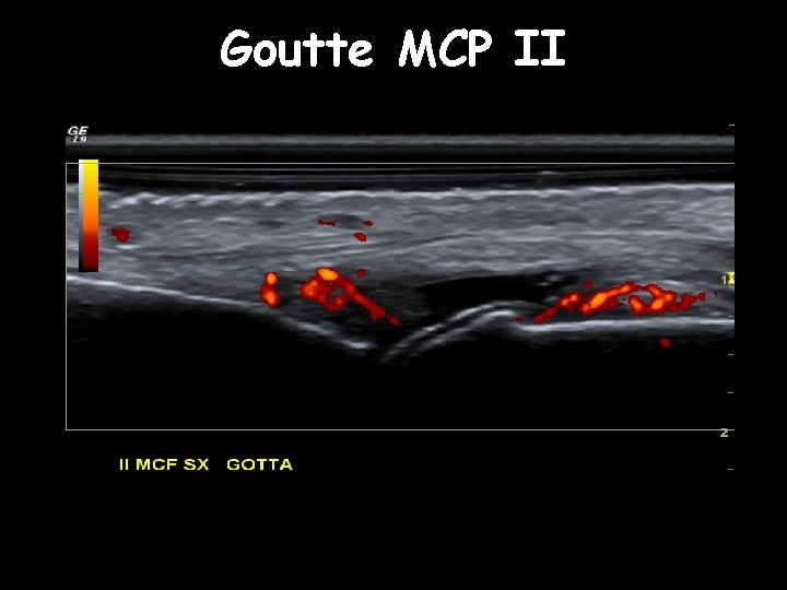 Goutte MCP II 