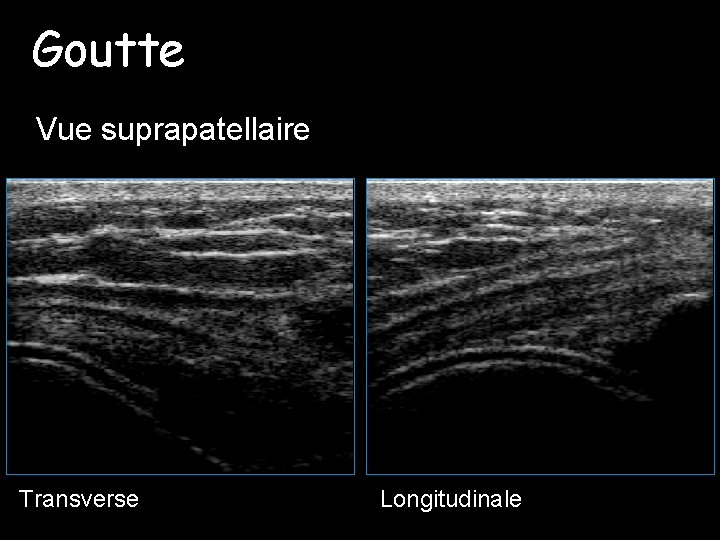 Goutte Vue suprapatellaire Transverse Longitudinale 