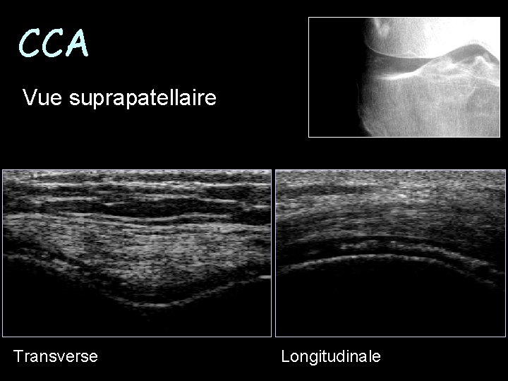 CCA Vue suprapatellaire Transverse Longitudinale 