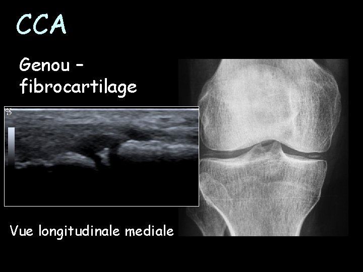 CCA Genou – fibrocartilage Vue longitudinale mediale 
