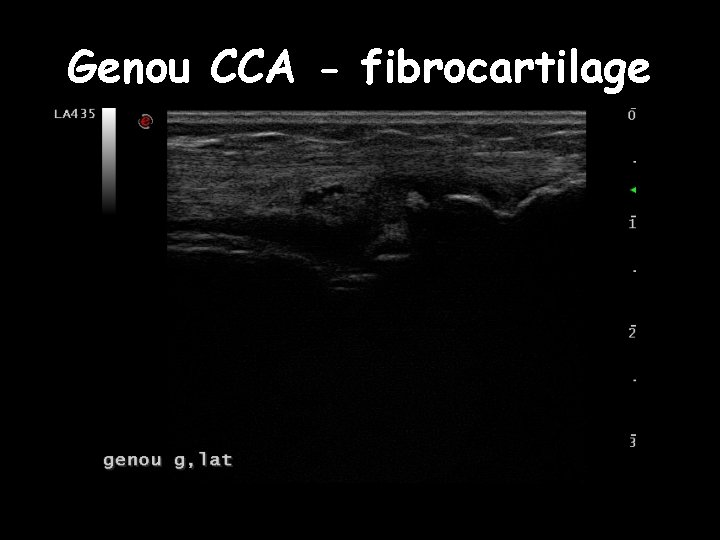 Genou CCA - fibrocartilage 