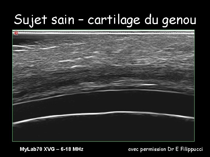 Sujet sain – cartilage du genou My. Lab 70 XVG – 6 -18 MHz
