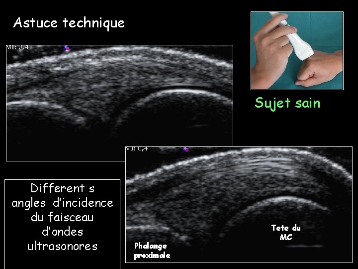 Astuce technique Sujet sain Different s angles d’incidence du faisceau d’ondes ultrasonores Phalange proximale