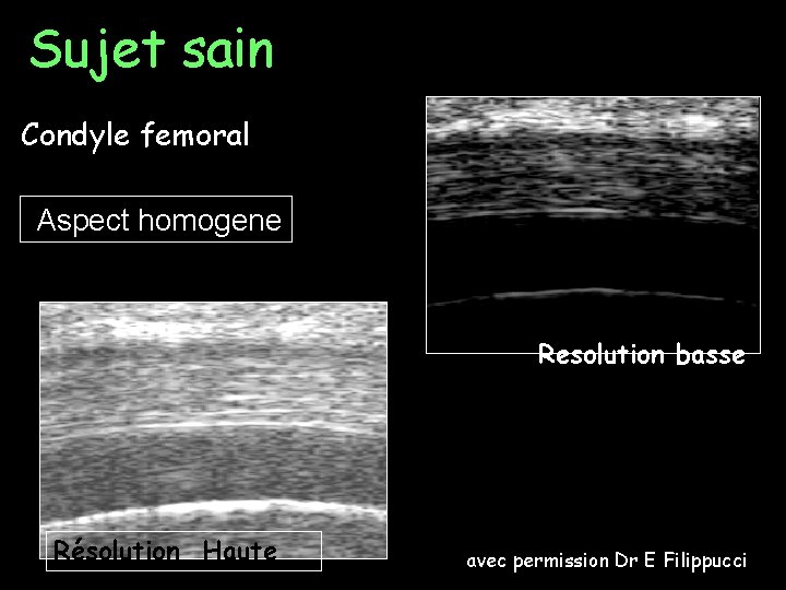 Sujet sain Condyle femoral Aspect homogene Resolution basse Résolution Haute avec permission Dr E