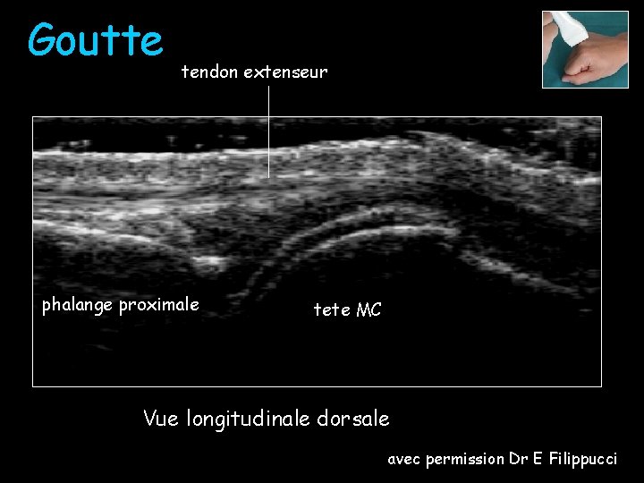 Goutte tendon extenseur phalange proximale tete MC Vue longitudinale dorsale avec permission Dr E