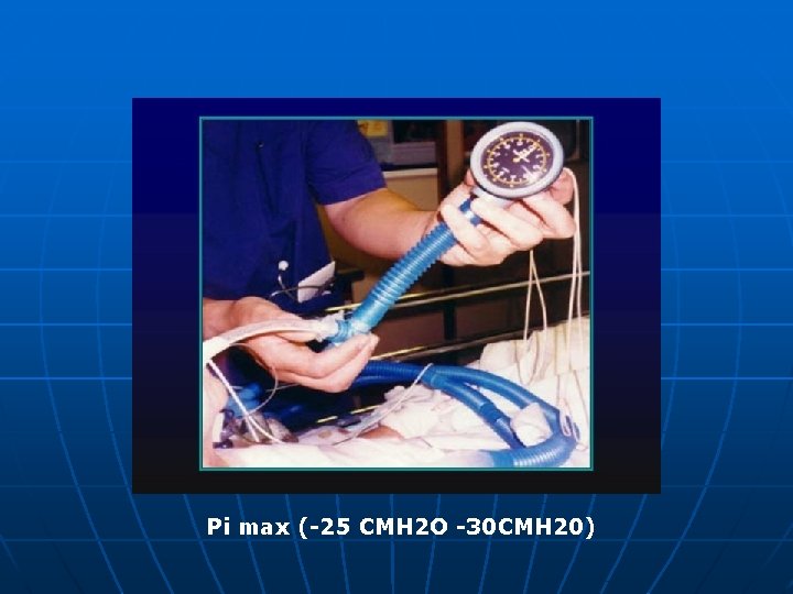 Pi max (-25 CMH 2 O -30 CMH 20) 