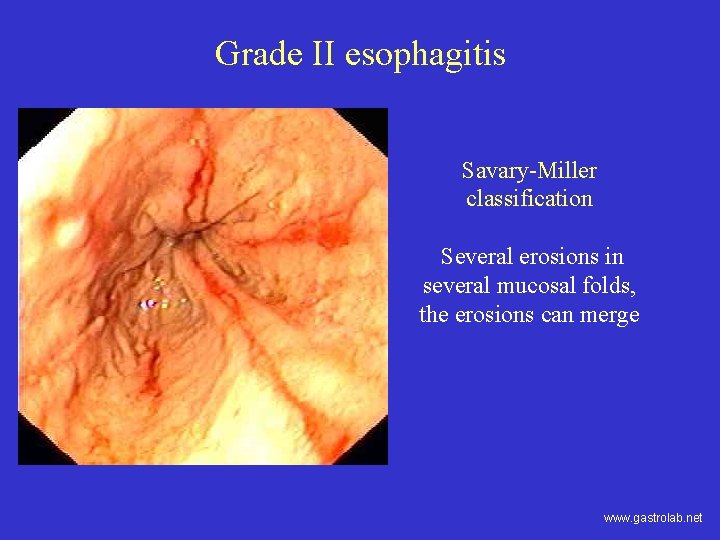 Grade II esophagitis Savary-Miller classification Several erosions in several mucosal folds, the erosions can