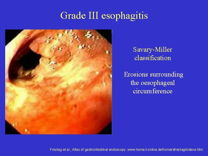 Grade III esophagitis Savary-Miller classification Erosions surrounding the oesophageal circumference Freytag et al. ,